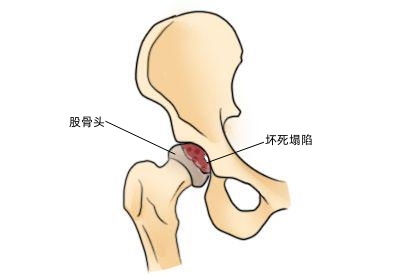 股骨头坏死塌陷图